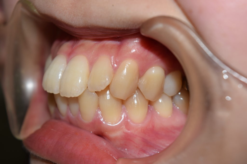 矯正治療症例☆前歯の突出感 インビザライン矯正 名古屋